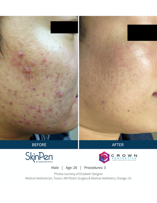 SkinPen MicroNeedling Before and After — Bryant, AR — Practical Wellness Clinic SkinPen MicroNeedling Before and After — Bryant, AR — Practical Wellness Clinic