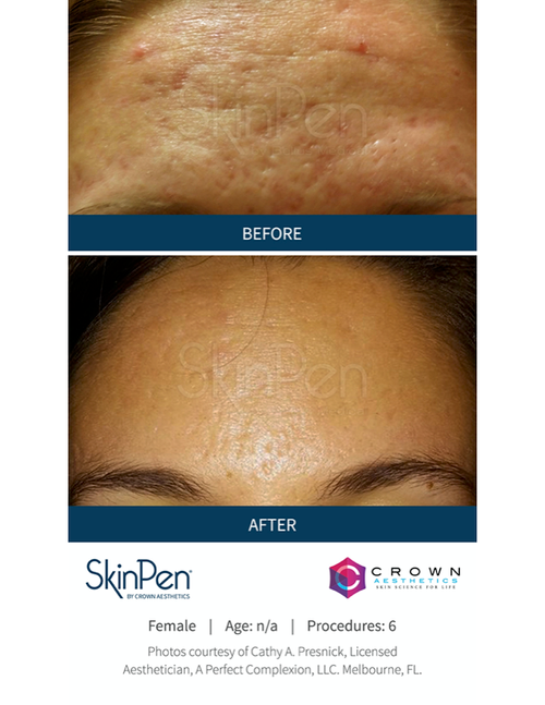 Microneedling with PRP Before and After — Bryant, AR — Practical Wellness Clinic Microneedling with PRP Before and After — Bryant, AR — Practical Wellness Clinic
