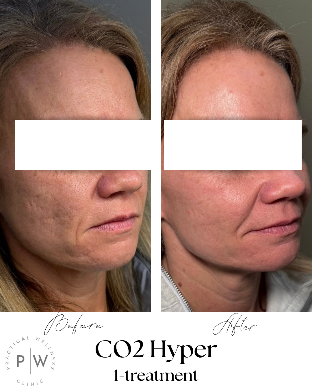 Before-and-after facial profile photos showing smoother skin after CO2 laser treatment