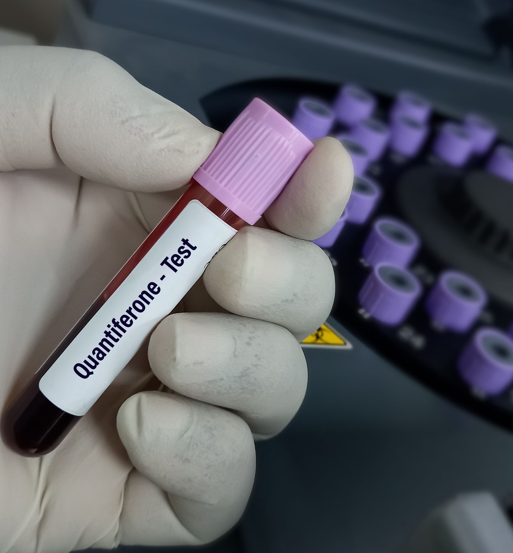 Gloved hand holding a blood-filled test tube labeled 