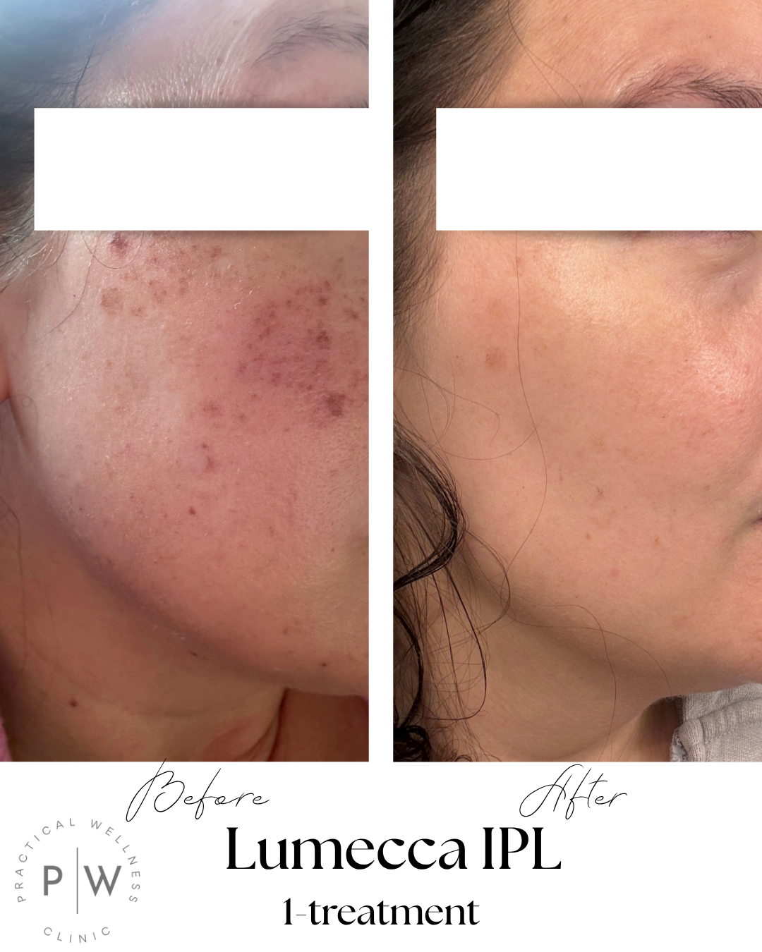 Side-by-side facial cheek before-and-after skin treatment comparison with reduced redness and blemishes