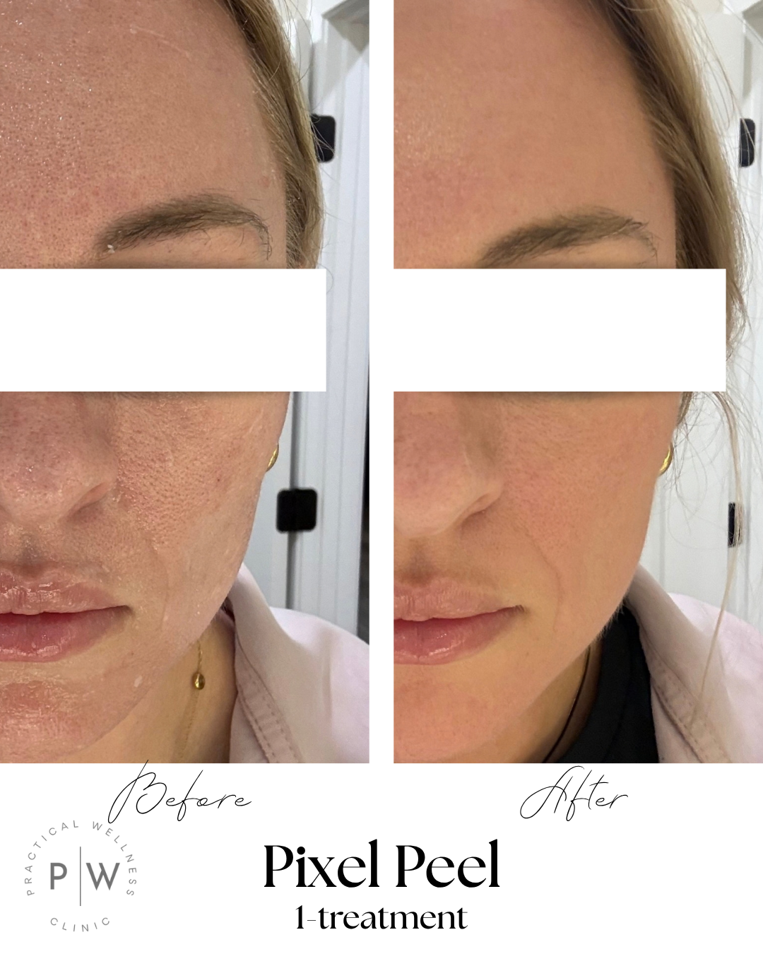 Before-and-after facial skin comparison showing visible improvement in redness and blemishes.