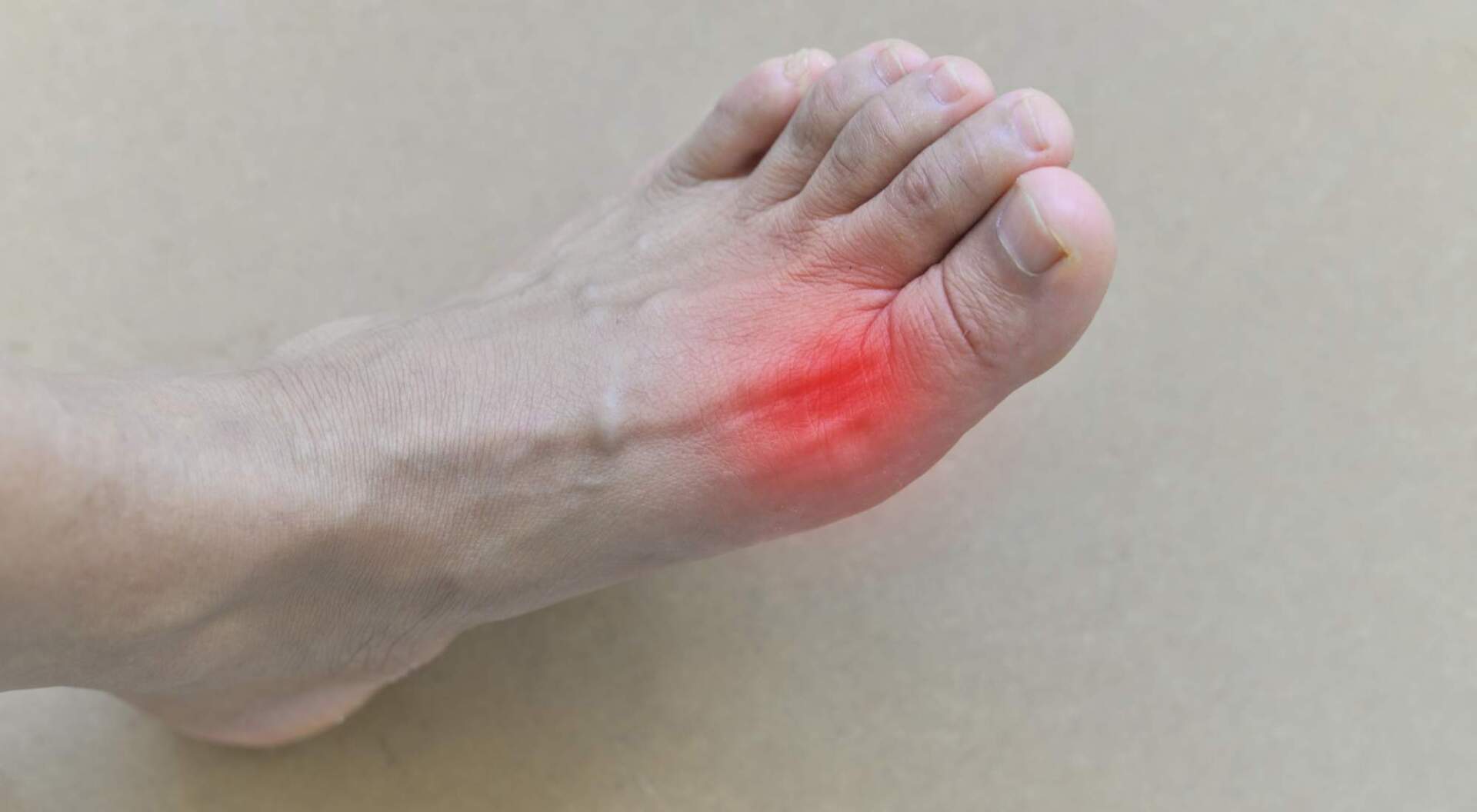 What Are the Foods To Avoid With Gout? HealthierU