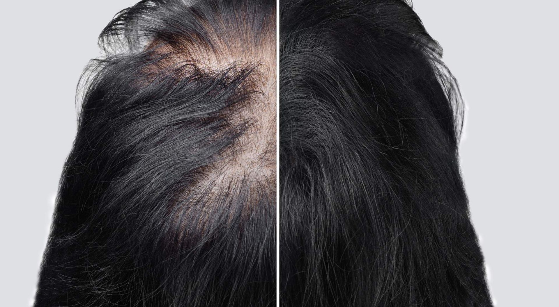 alopecia and diet