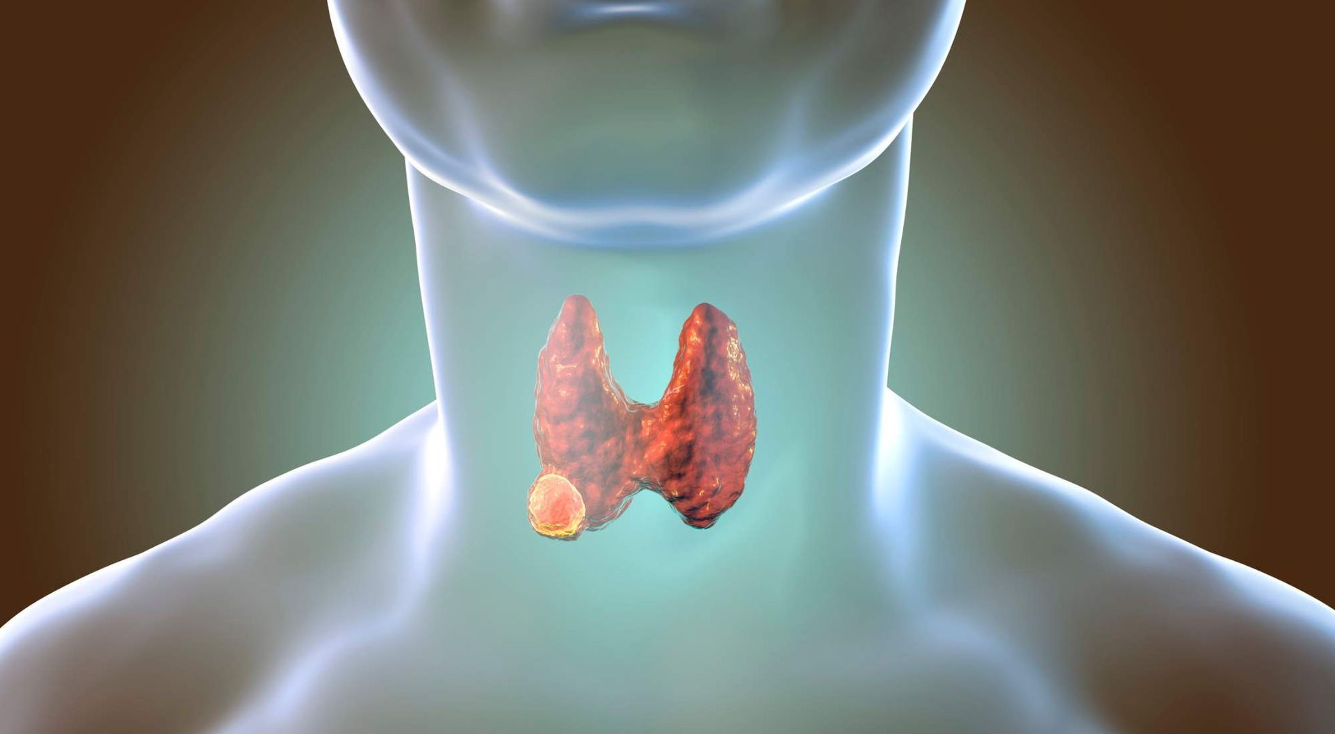can hyperthyroidism cause headaches