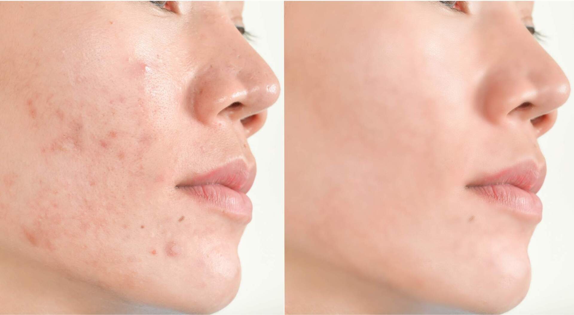 foods to eat for hormonal acne