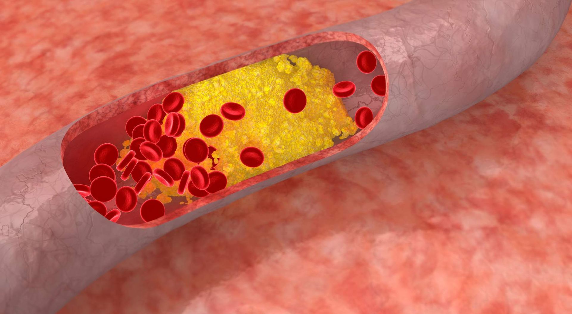 hashimotos and high cholesterol