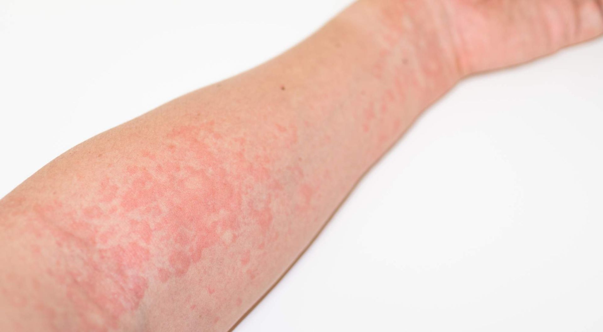  hashimoto's hives