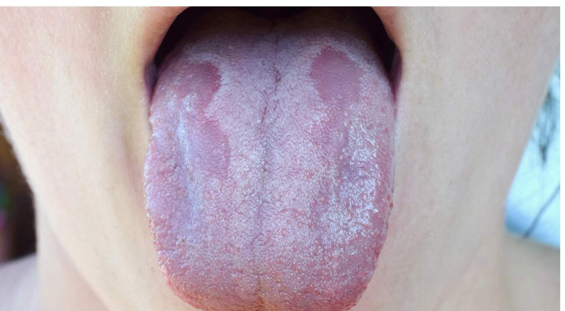 how to cure candida naturally and permanently