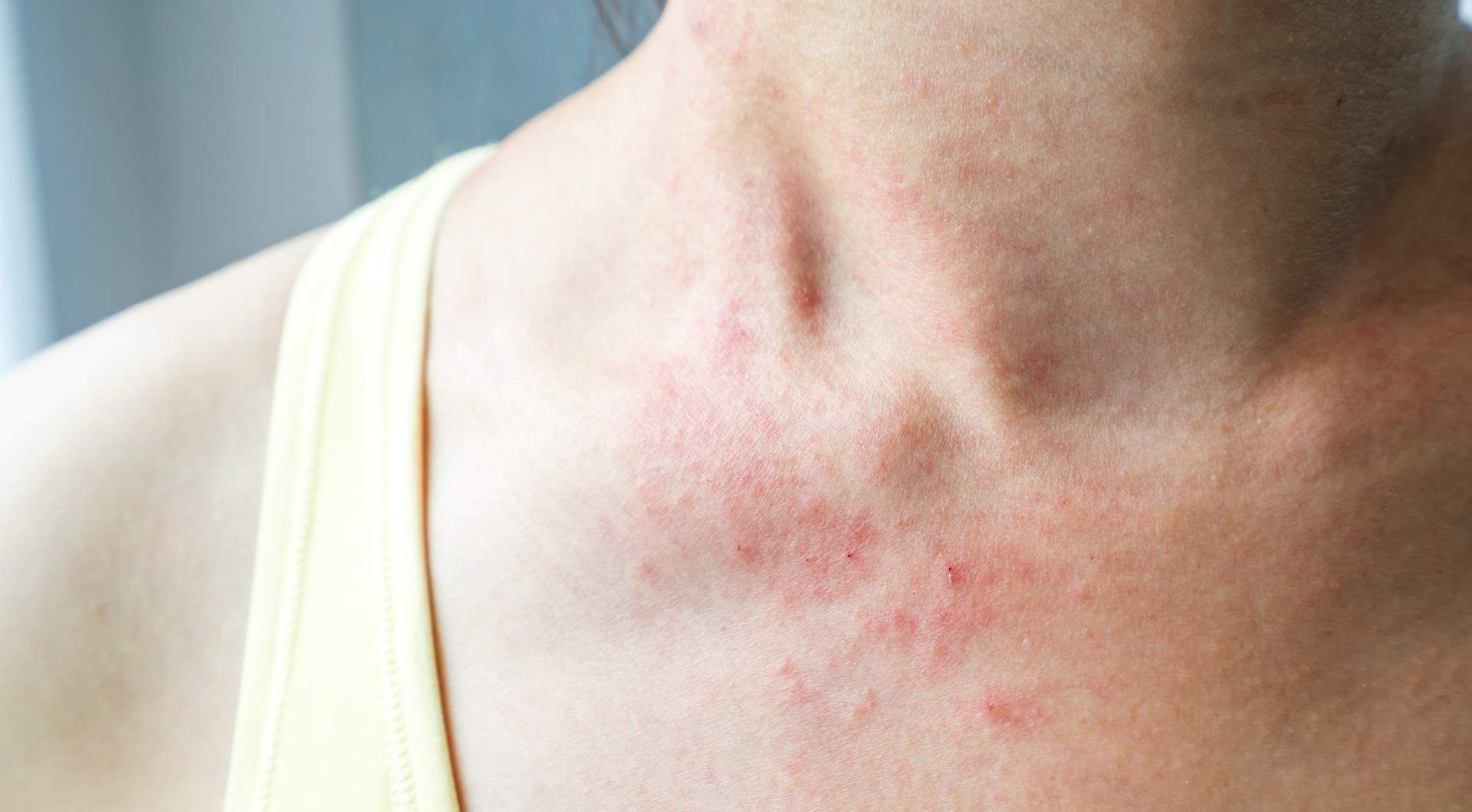 how to tell the difference between lupus and hashimoto's