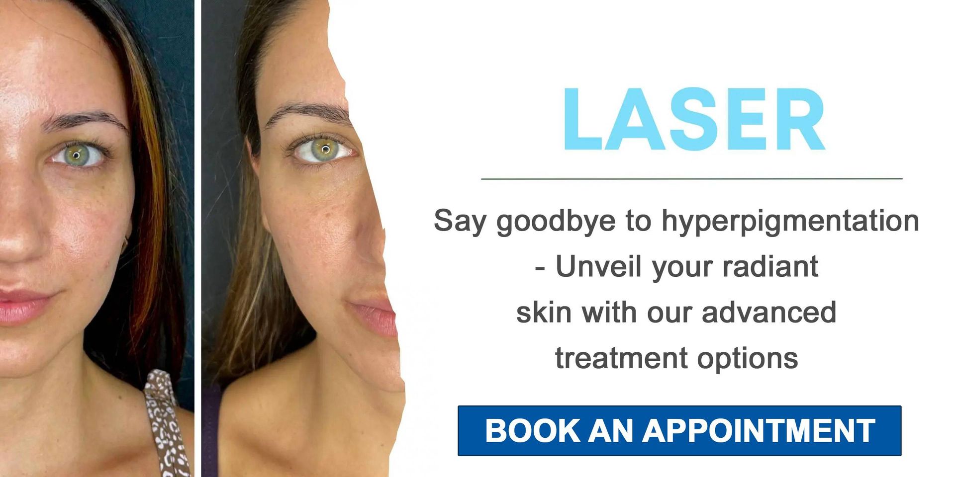 Advert for laser skin treatment; woman's face (before/after)