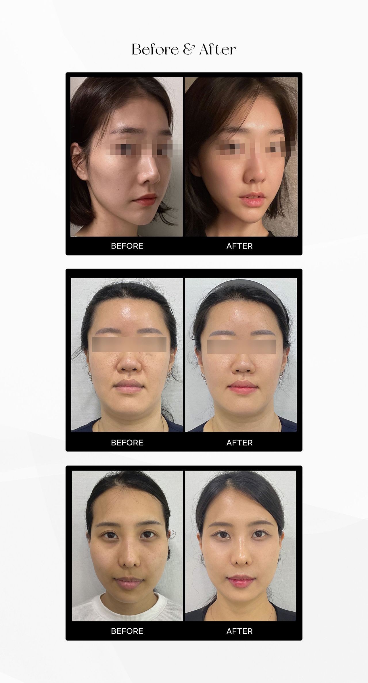 Juvelook before and after photos at Cheongdam Peau Rêve Clinic