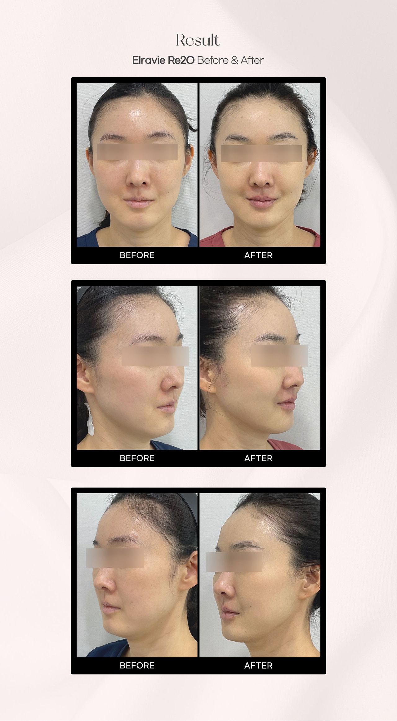 Elravie Re2O before and after photos at Cheongdam Peau Rêve Clinic