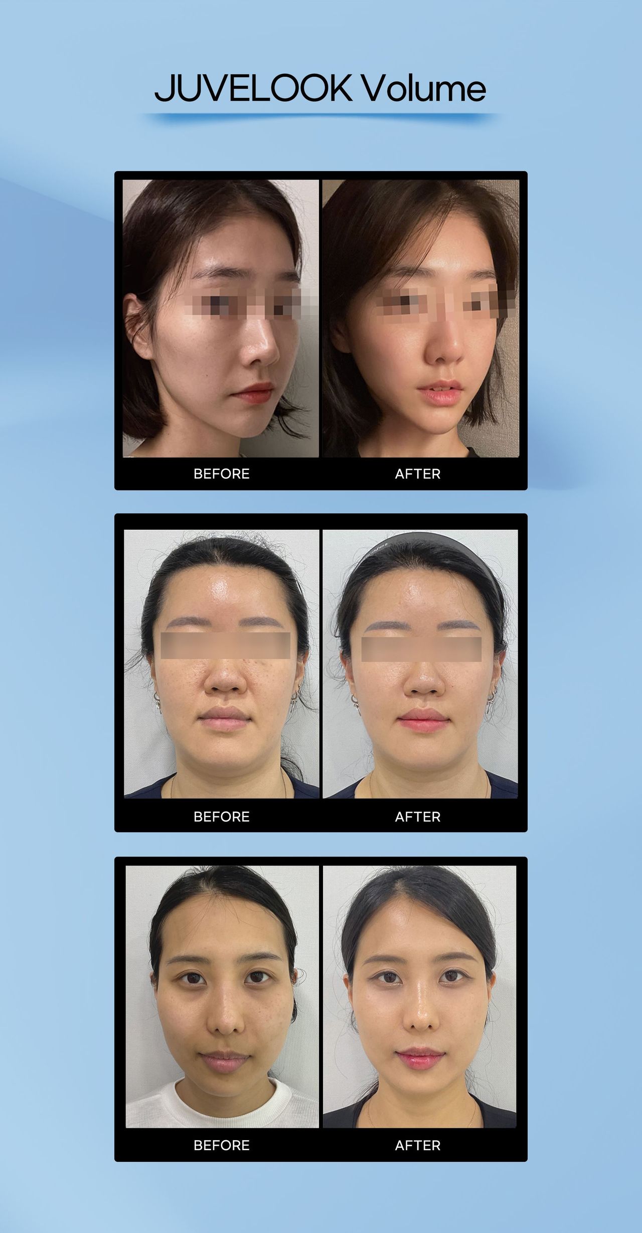 Juvelook Volume before and after photos at Cheongdam Peau Rêve Clinic