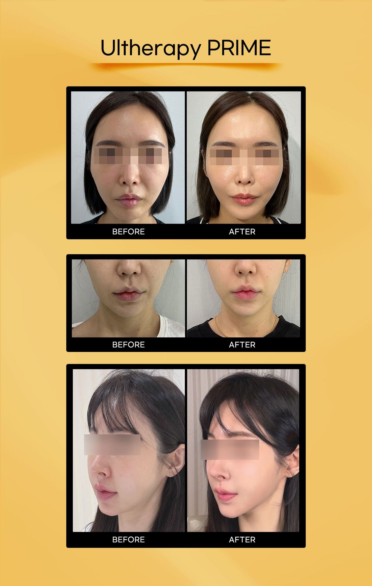 Ultherapy Prime before and after photos at Cheongdam Peau Rêve Clinic