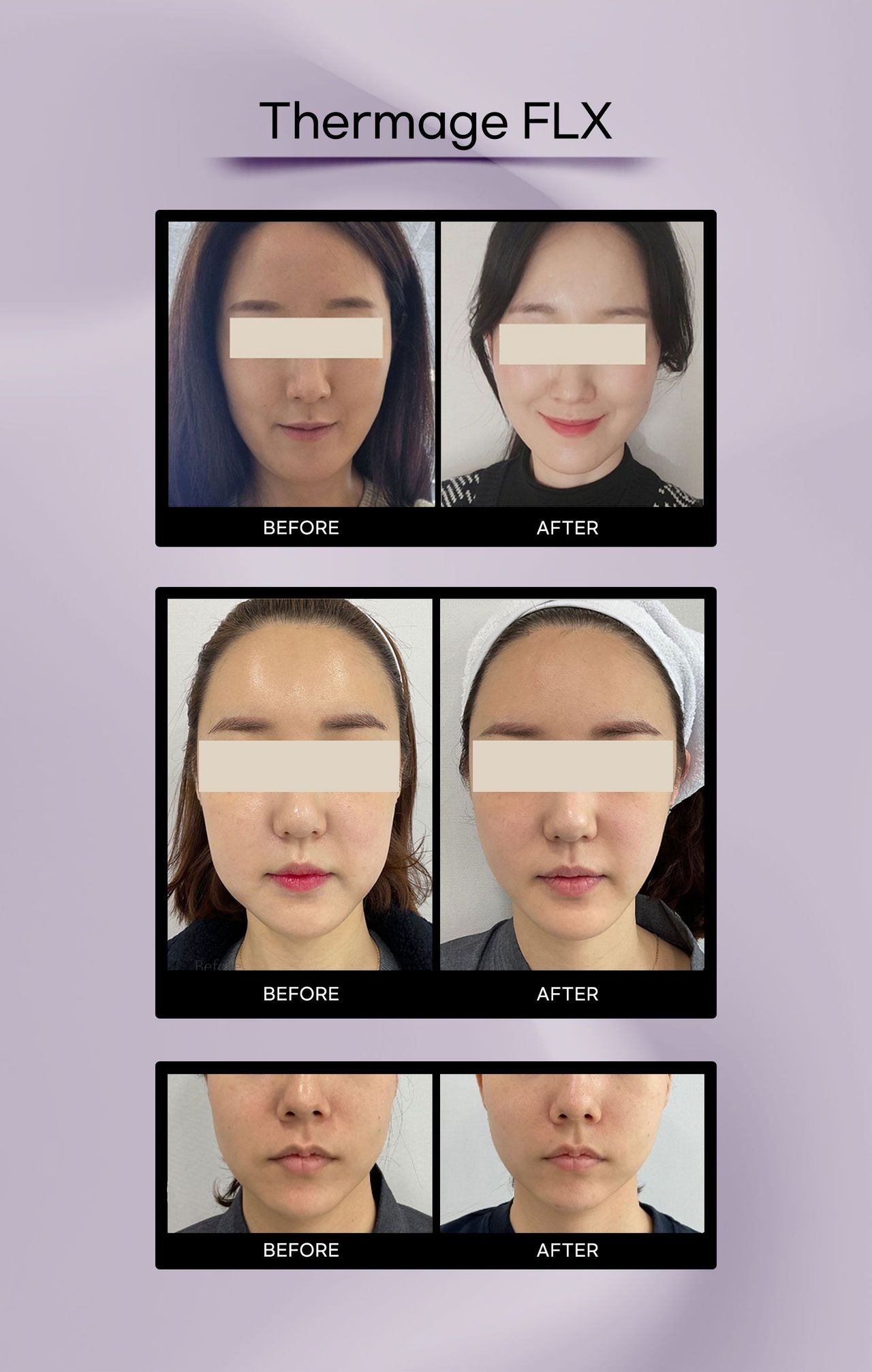 Thermage FLX before and after photos at Cheongdam Peau Rêve Clinic