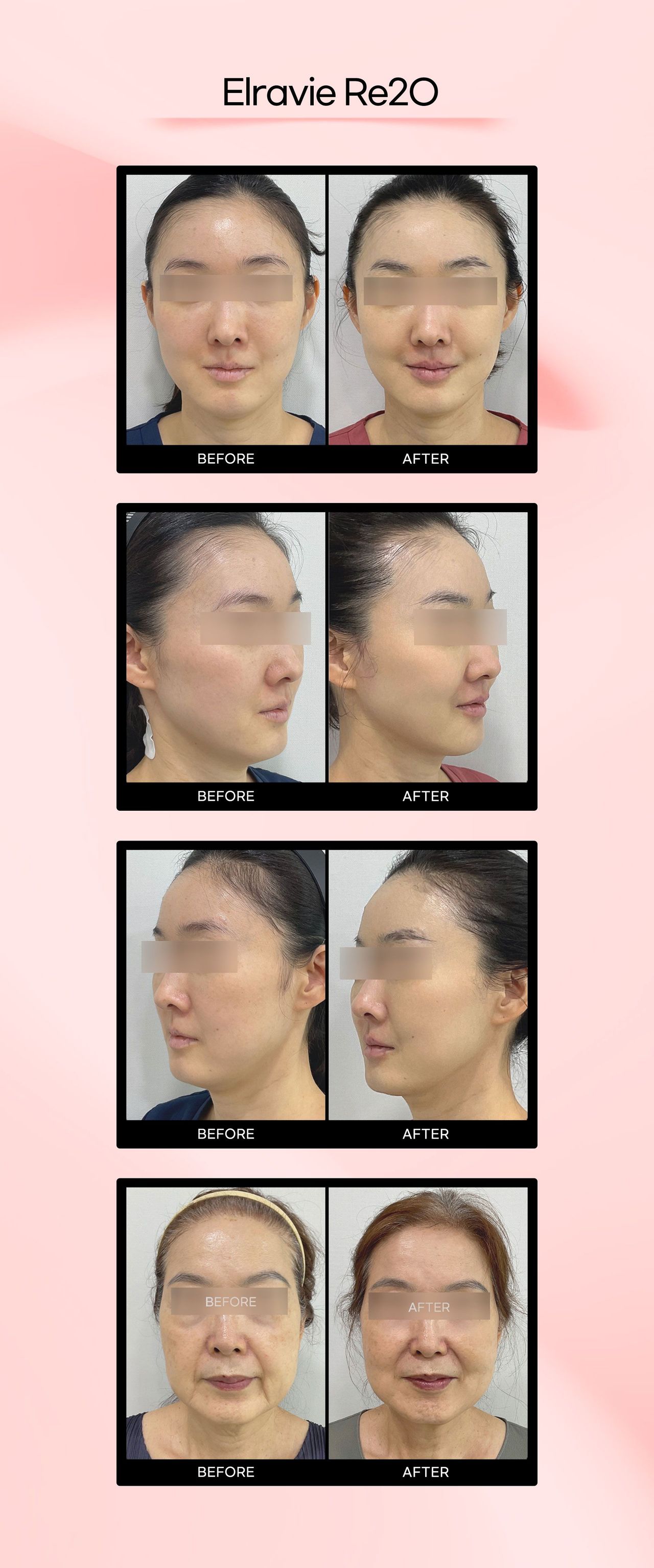 Elravie Re2O before and after photos at Cheongdam Peau Rêve Clinic
