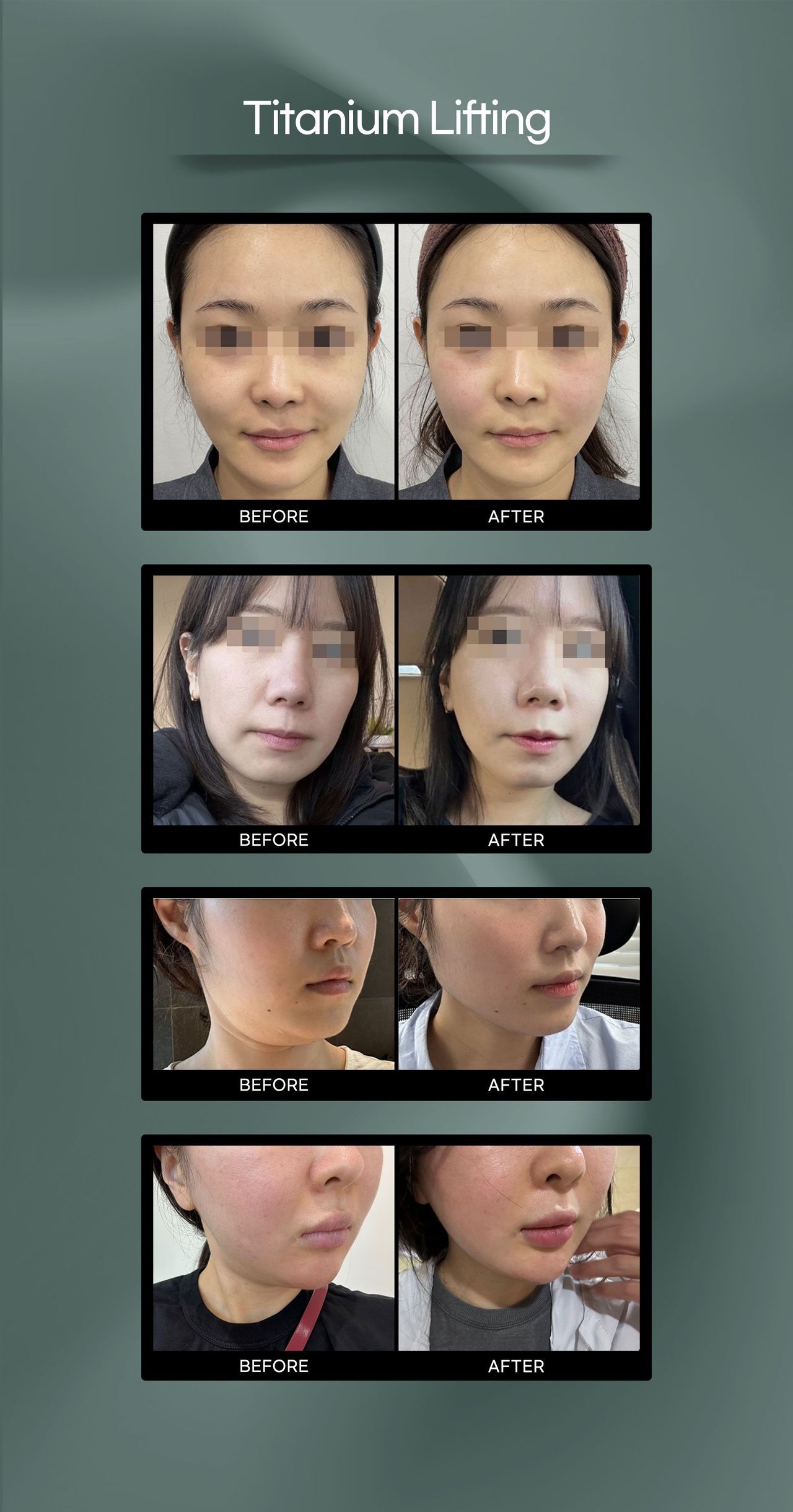 Titanium Lifting before and after photos at Cheongdam Peau Rêve Clinic