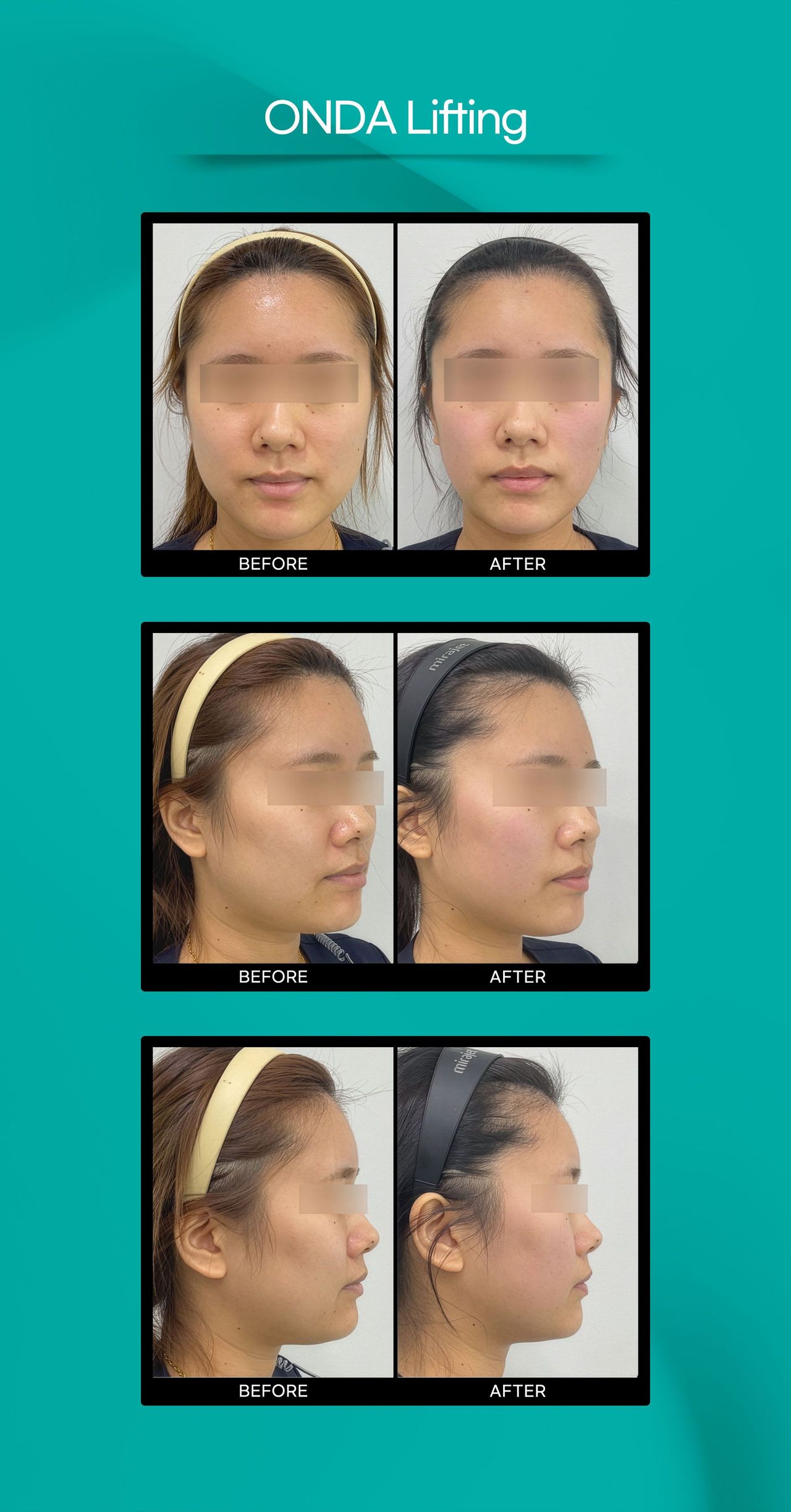 ONDA Lifting before and after photos at Cheongdam Peau Rêve Clinic