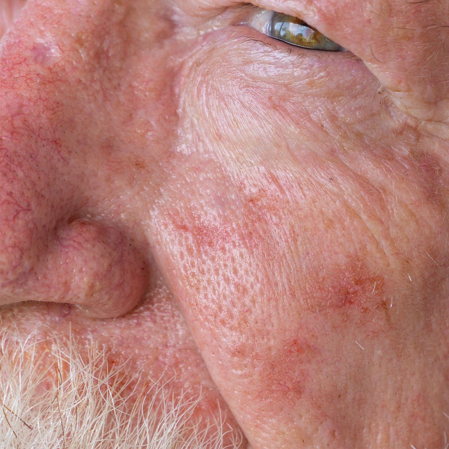 Topical Treatments