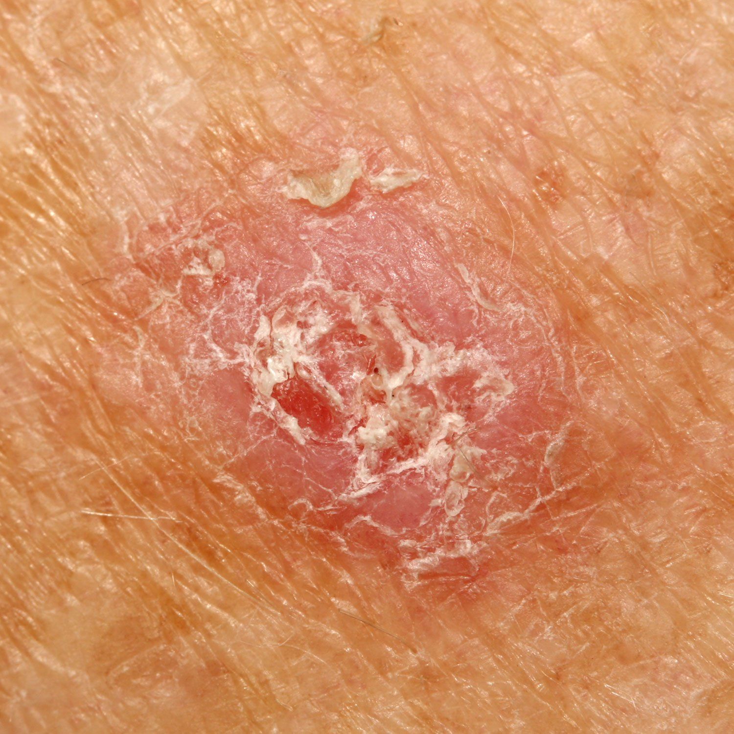 Squamous Cell Carcinoma