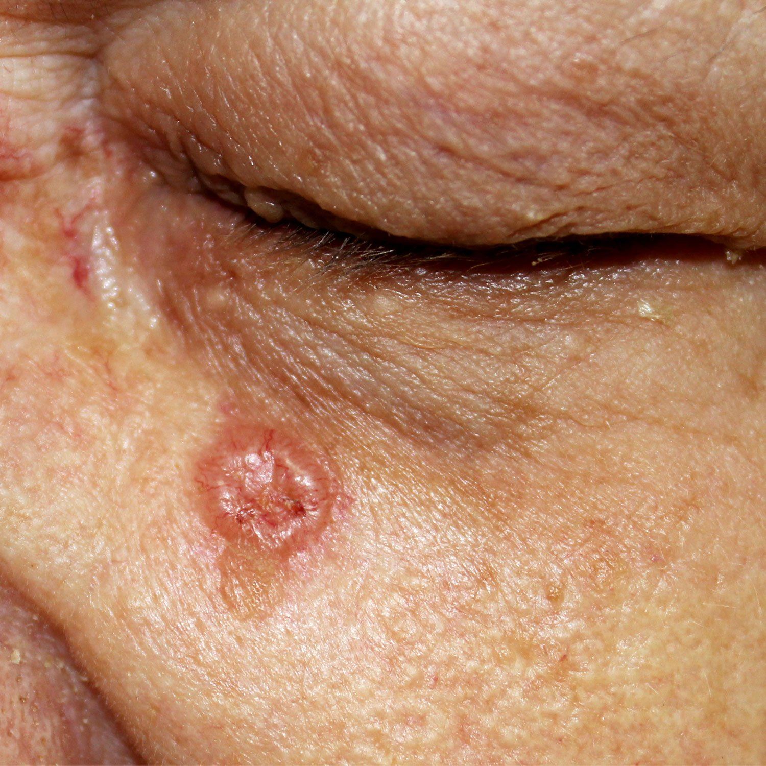 Basal Cell Carcinoma