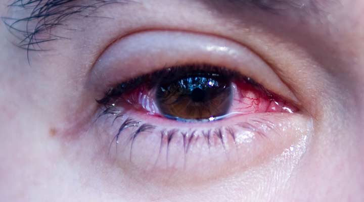 DR. LUIS OLMOS VALLADARES - Conjuntivitis