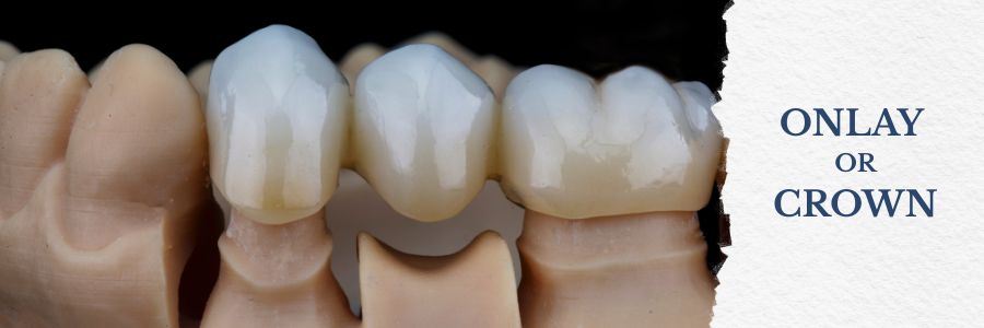 A close up of a set of teeth with the words onlay or crown on the bottom.
