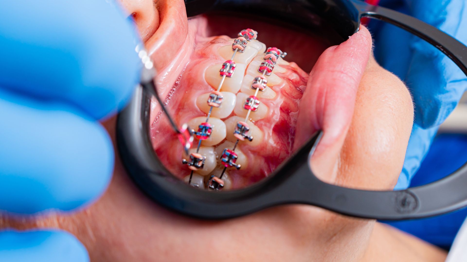 Close-up of braces being adjusted on teeth by gloved hands with a dental tool