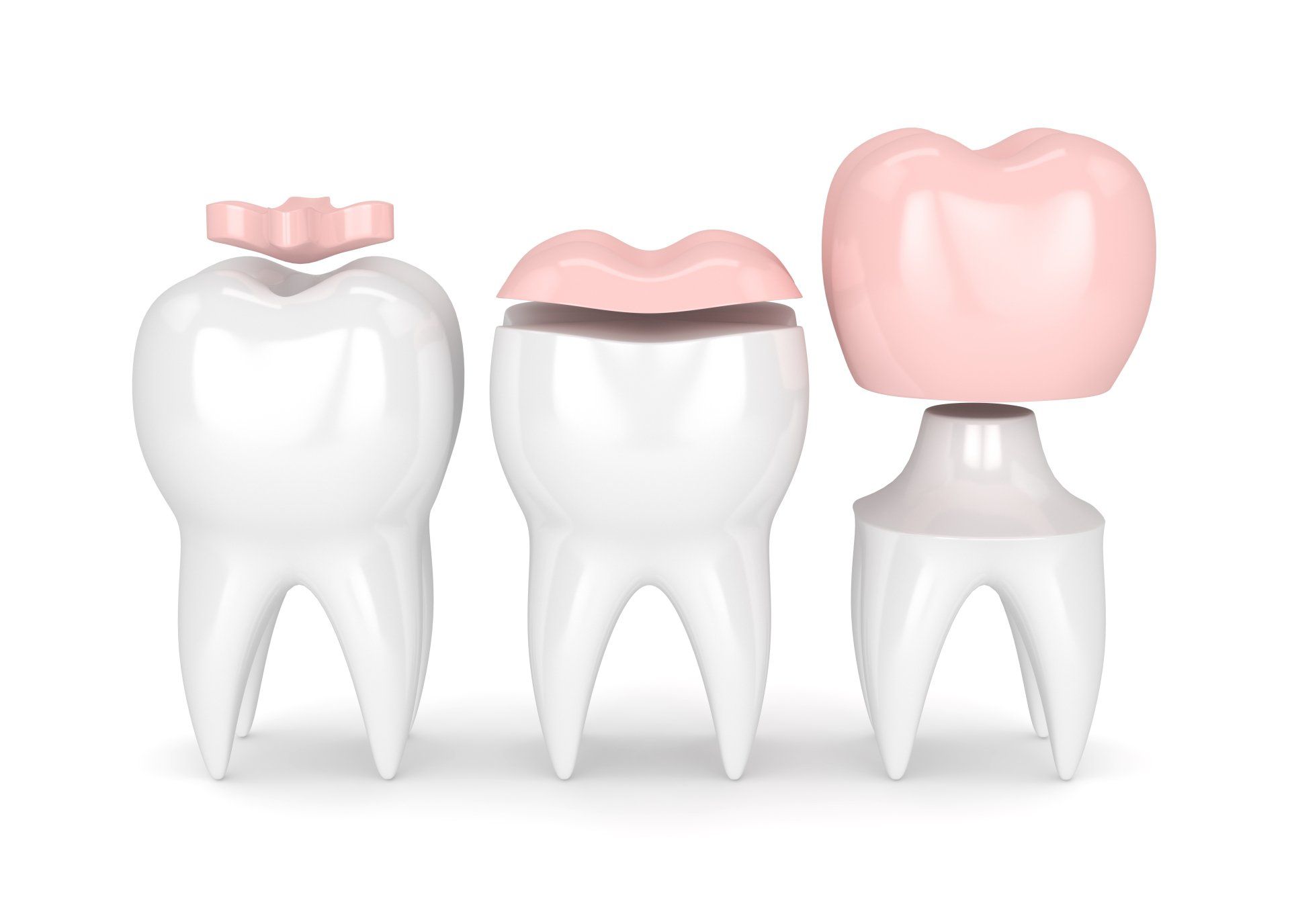Three teeth with different types of dental fillings on them.
