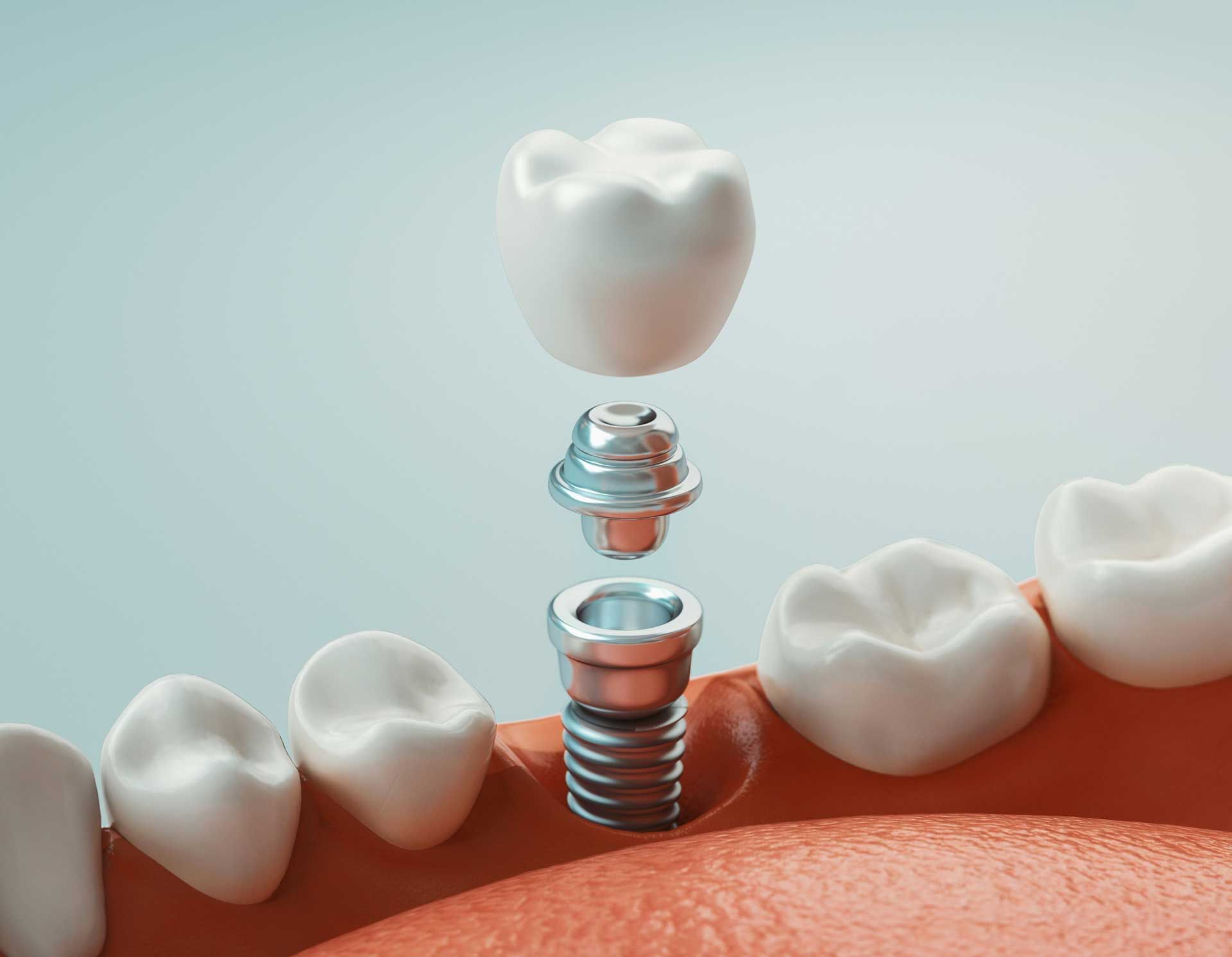 Dental Implants — Fairbanks, AK — Barrera Dental, PC