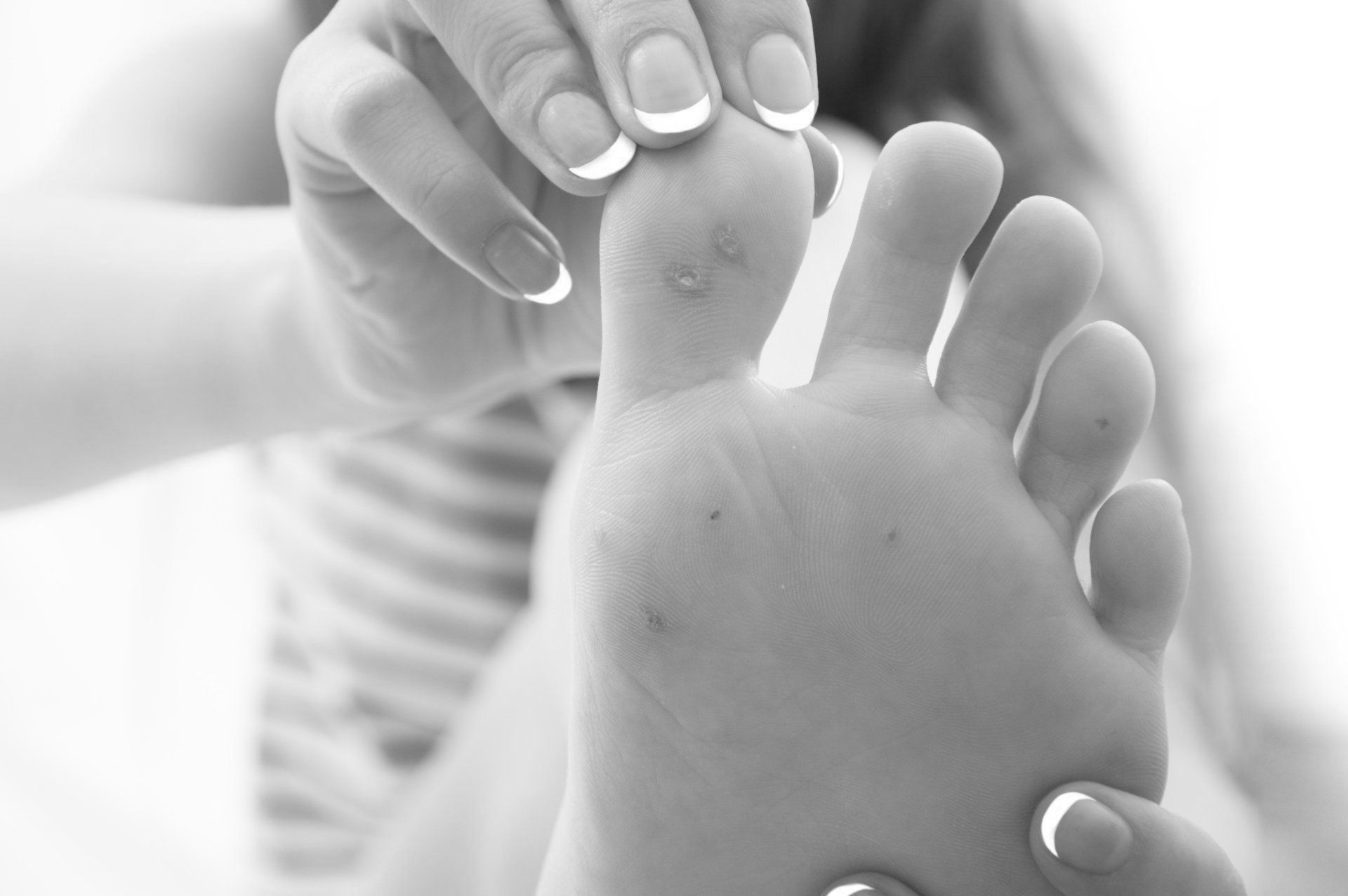 black and white close up photo of a woman's bottom feet showing visible warts white she holds her big toe
