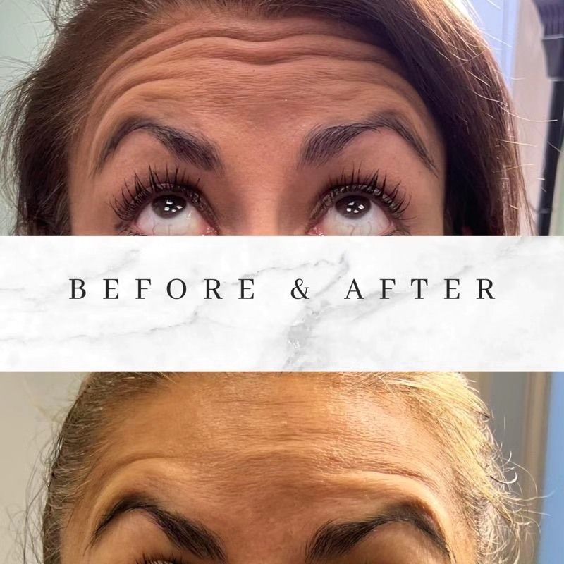 A before and after photo of a woman 's forehead