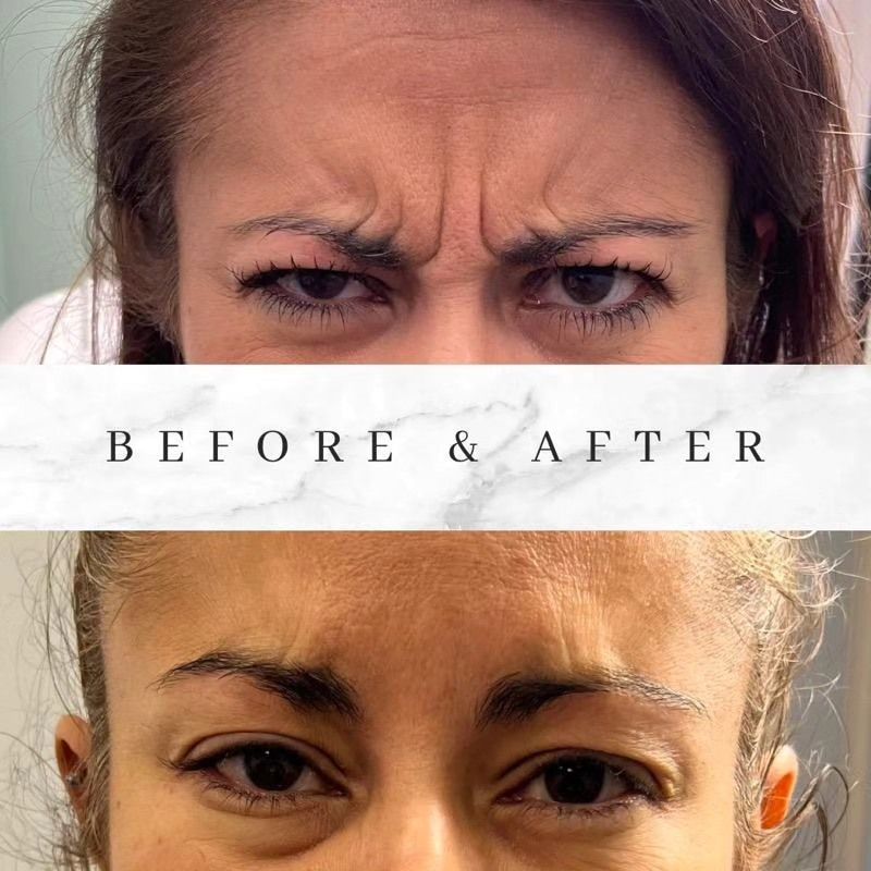 A before and after photo of a woman 's forehead with wrinkles.
