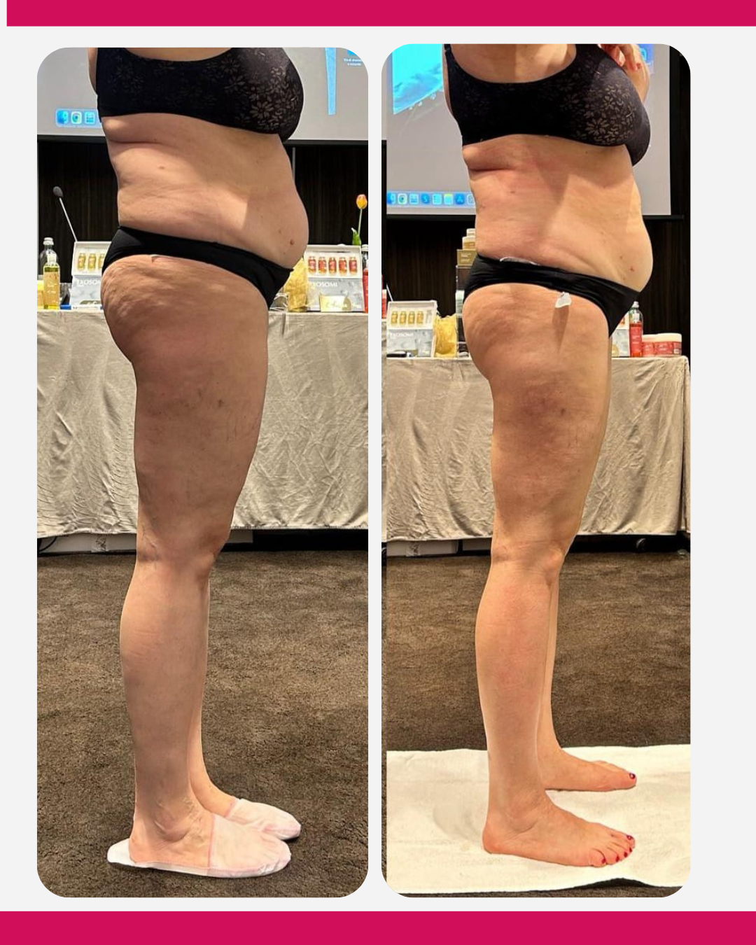 Side-by-side photo of a person’s torso and legs, showing before-and-after weight loss in black underwear.