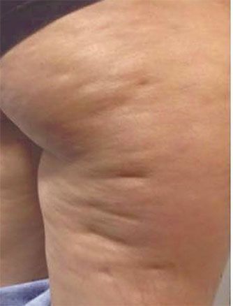 primo piano glutei post trattamento di estetica avanzata