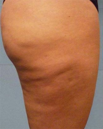 La coscia di una donna con molta cellulite sopra.