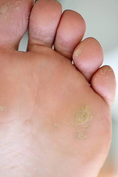 Close-up of human foot, showing sole with areas of rough, yellowish skin, possibly warts.