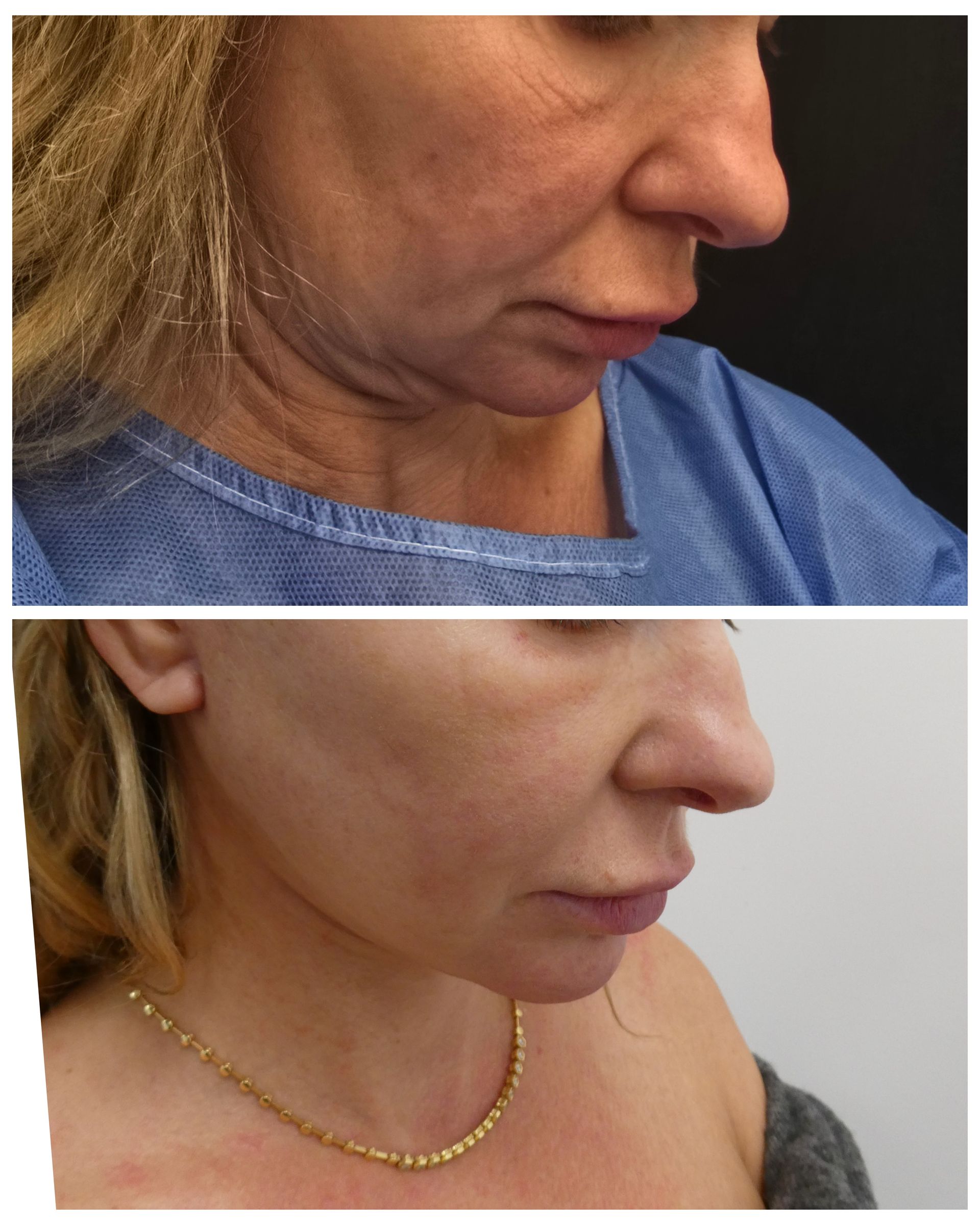 Facelift and lower lid blepharoplasty