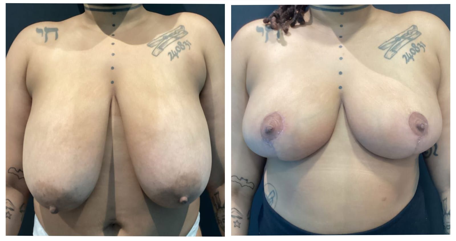 Breast Reduction before and after