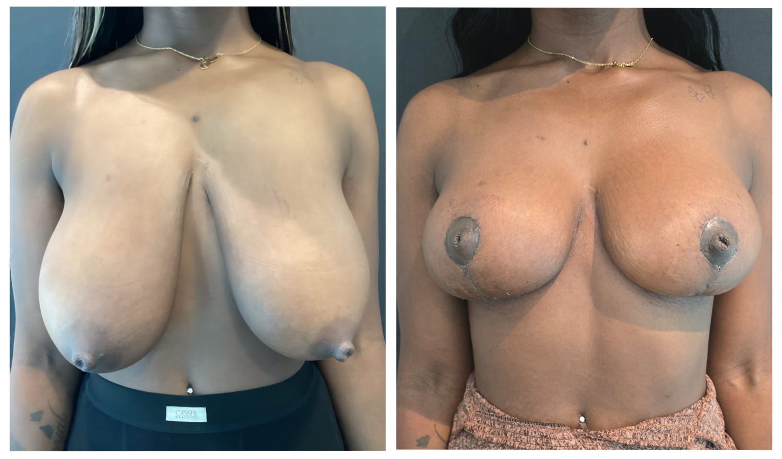Breast Reduction before and after
