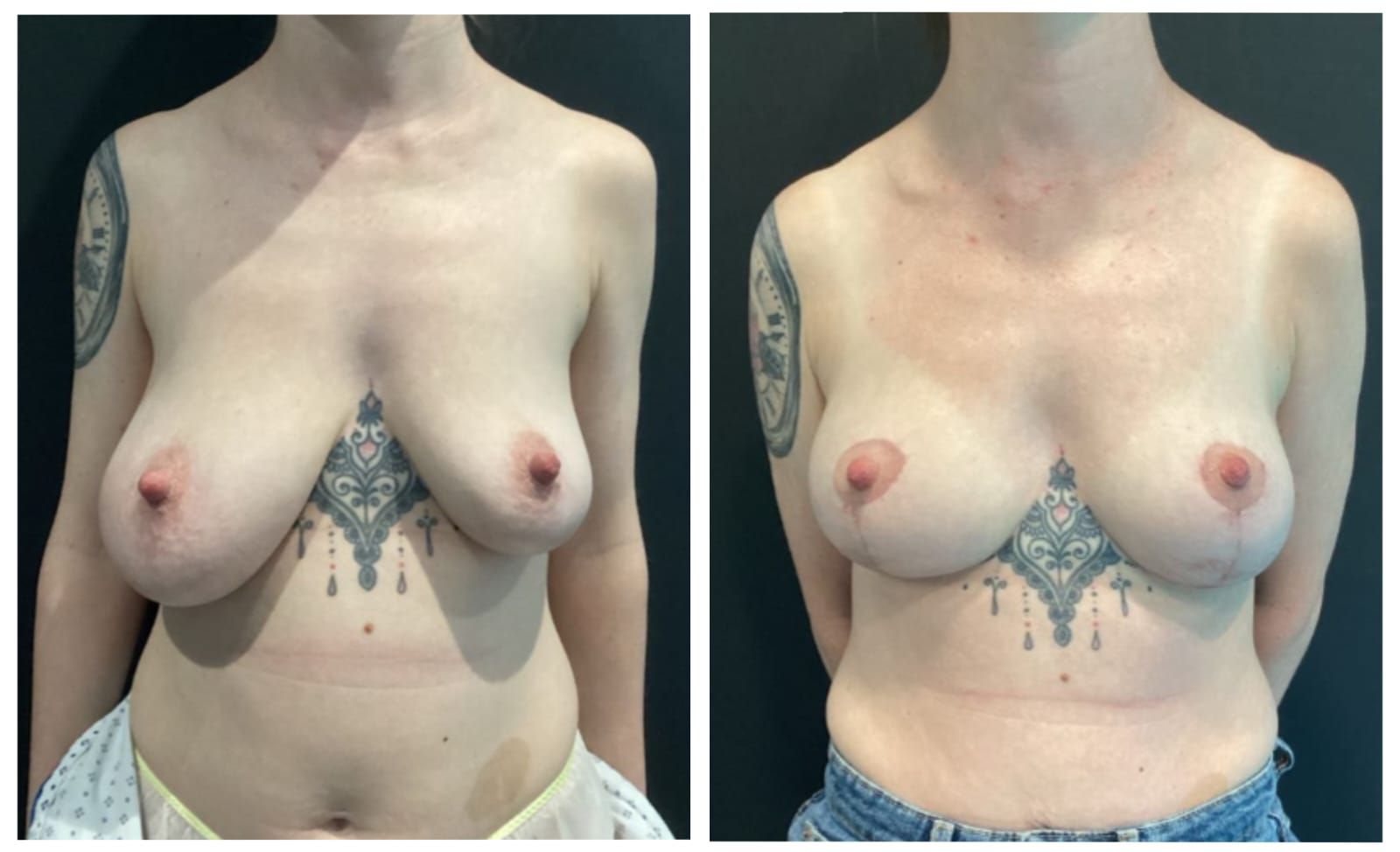 Breast Reduction before and after