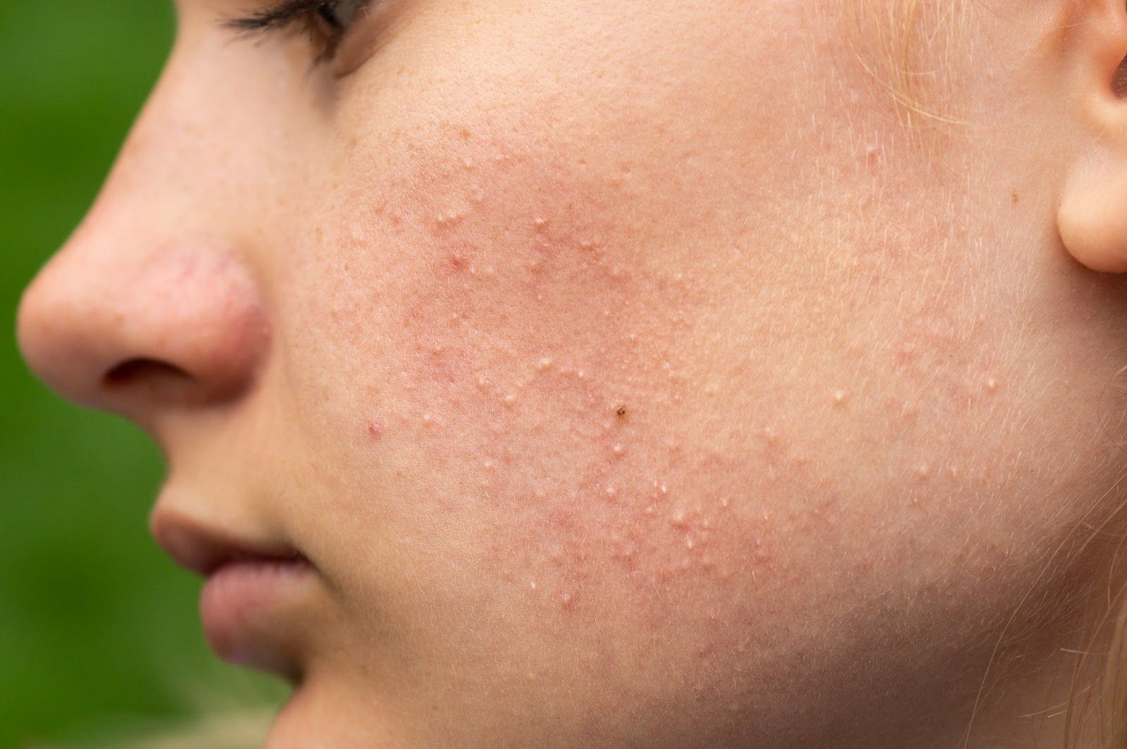 Close-up of a cheek with visible acne and skin texture in side profile.