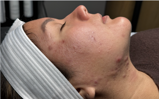 Close-up of a person's side profile with acne spots and a white headband, lying down with eyes closed.