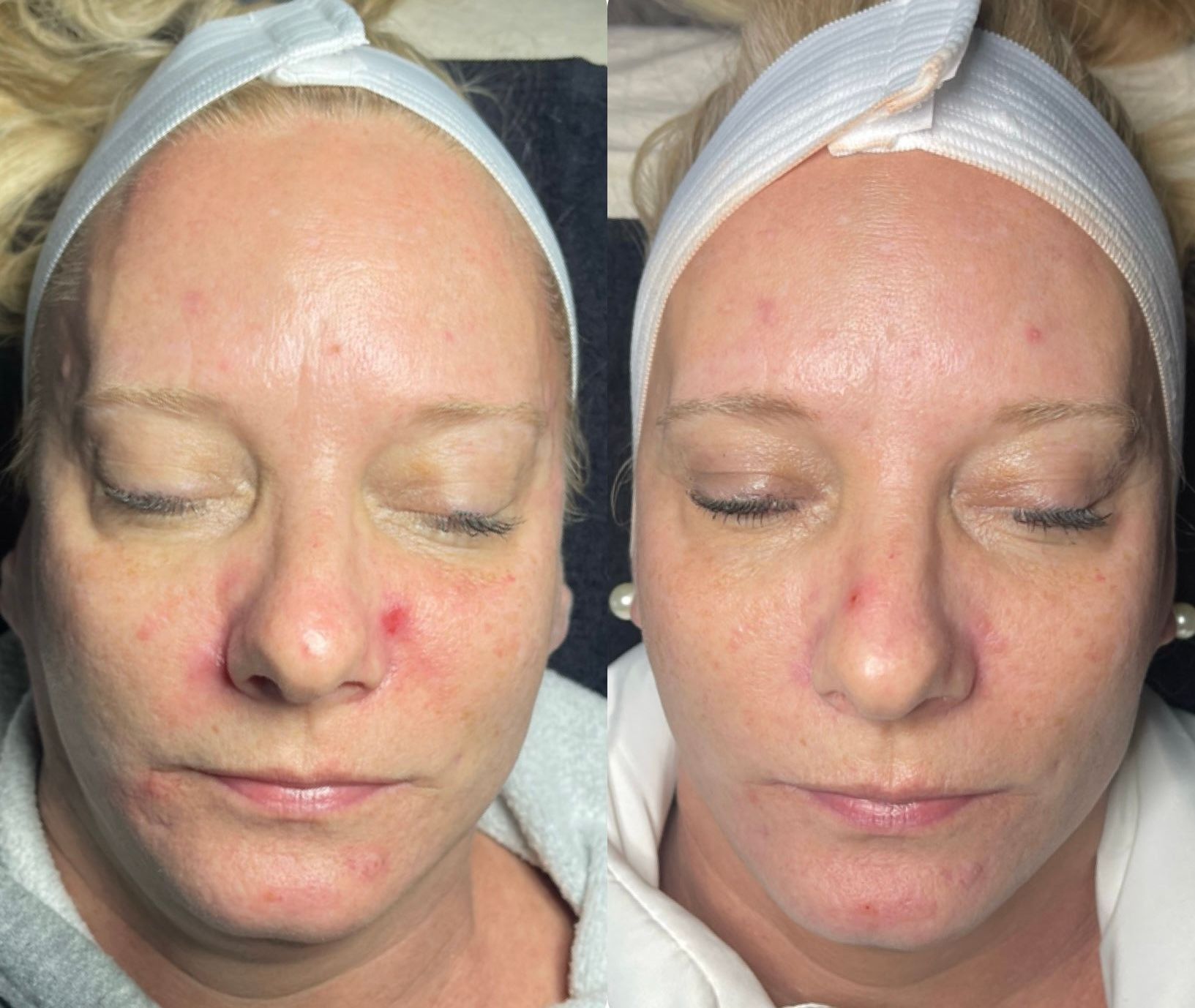 Before-and-after close-up of a face with reduced redness on the nose and cheeks.