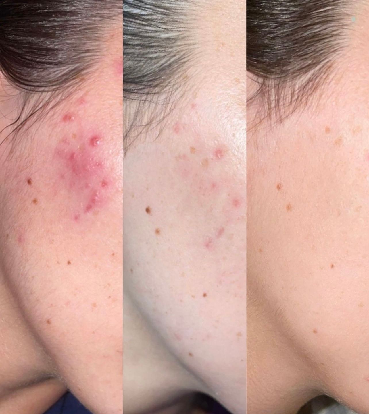Three side-by-side close-ups of a cheek with red acne spots fading to clearer skin