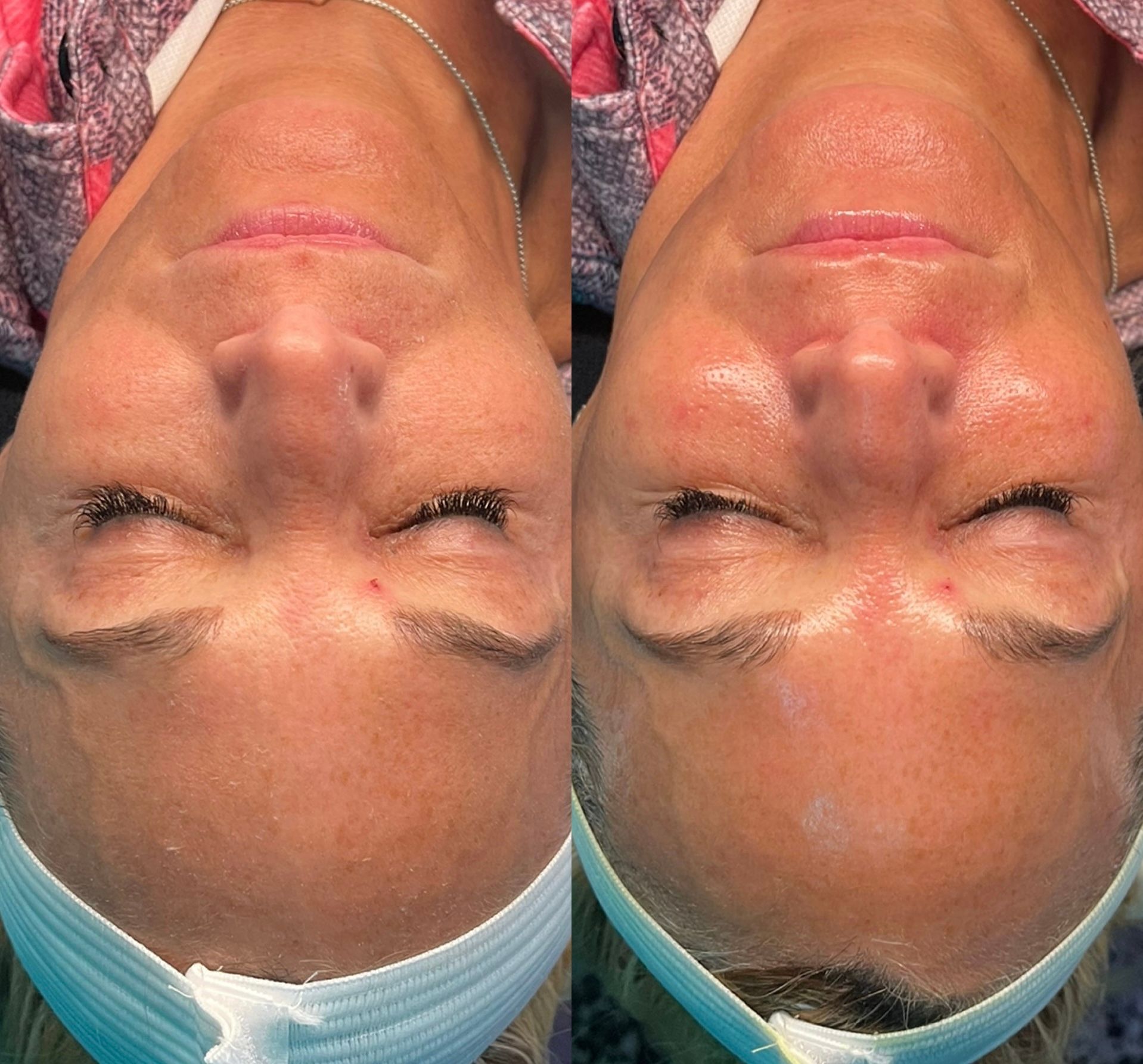 Upside-down close-up of a woman’s face with bruising under both eyes, shown side by side.