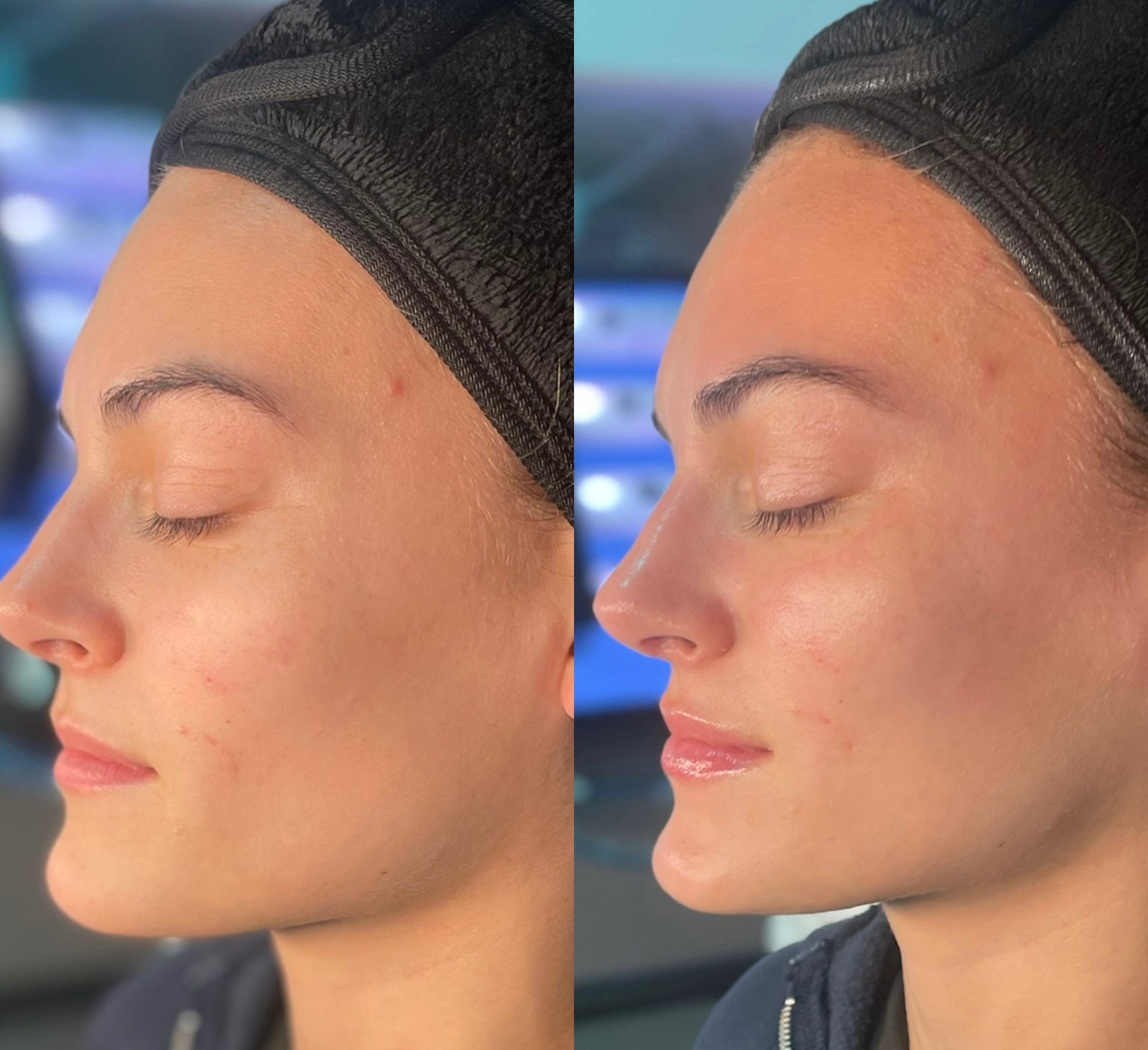 Side-by-side profile faces with closed eyes, showing a nose and cheek before-and-after comparison.