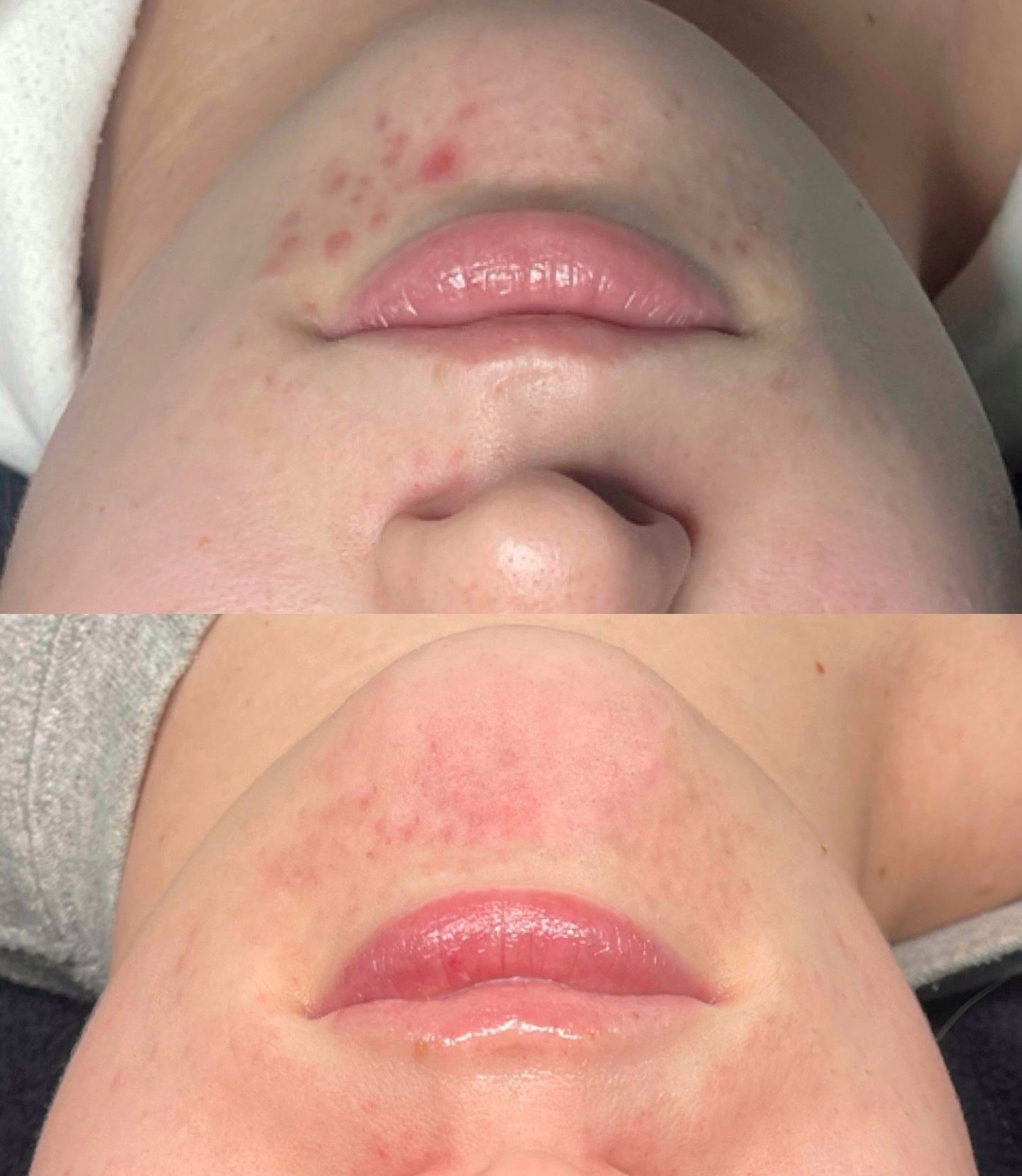 Two close-up lip photos showing red rash-like spots above the upper lip and a calmer area below.