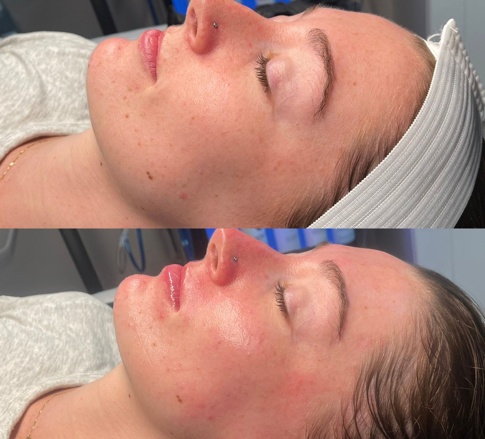 Side-by-side profile close-ups of a woman with eyes closed, showing a facial treatment result on her cheek and nose.